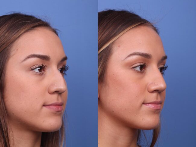 مشاهده تورم بینی دلیل تورم بینی