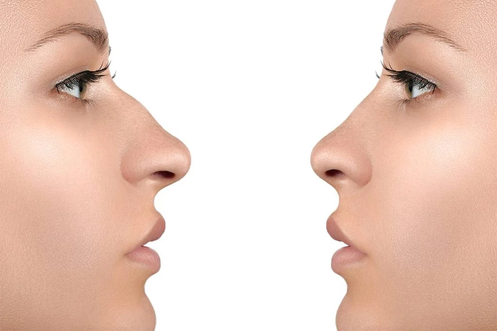 اجرای عمل بینی کج