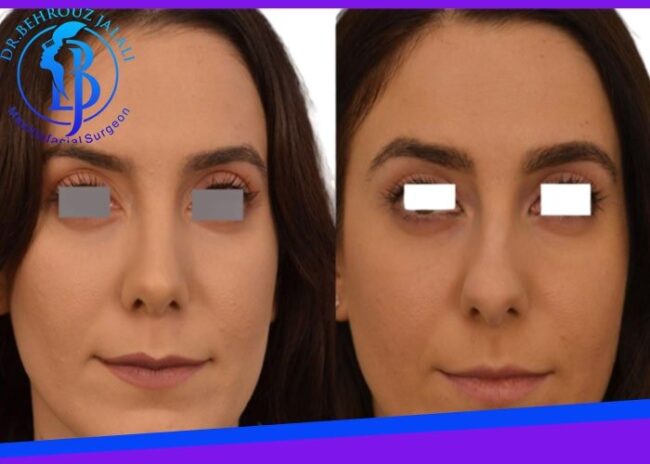 انحراف بینی و علائم و درمان آن انحراف بینی و علائم و درمان آن