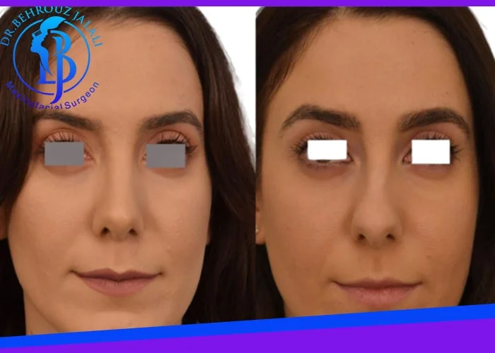 انحراف بینی و علائم و درمان آن