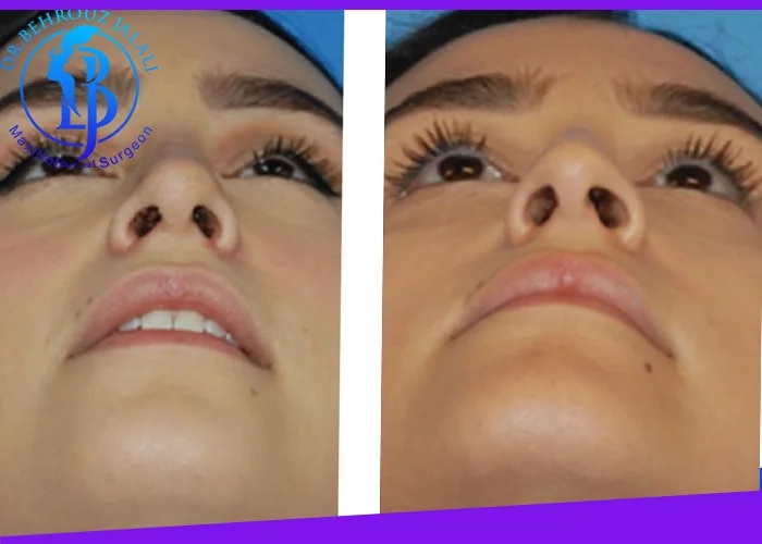 عدم تقارن سوراخهای بینی بعد از عمل