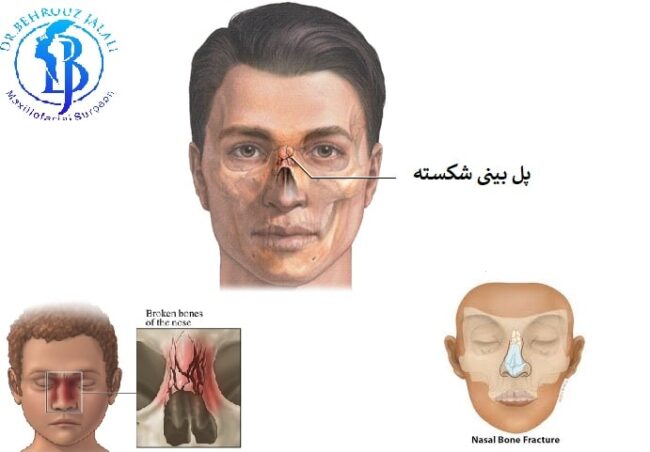 بینی شکسته چه علائمی دارد؟ بینی شکسته چه علائمی دارد؟