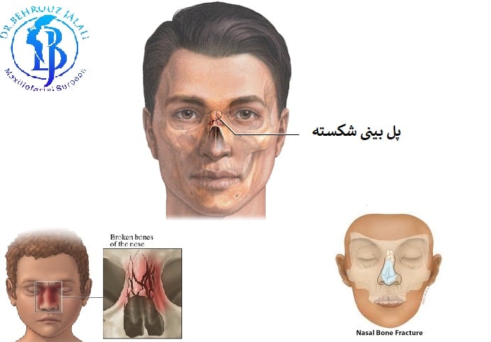 بینی شکسته چه علائمی دارد؟