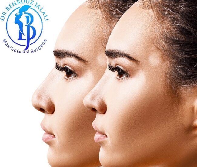 عمل تیپ پلاستی بینی چیست؟ عمل تیپ پلاستی بینی چیست؟