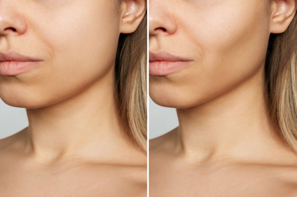 مقایسه قبل و بعد از جراحی بوکال فت یا فرم دهی صورت