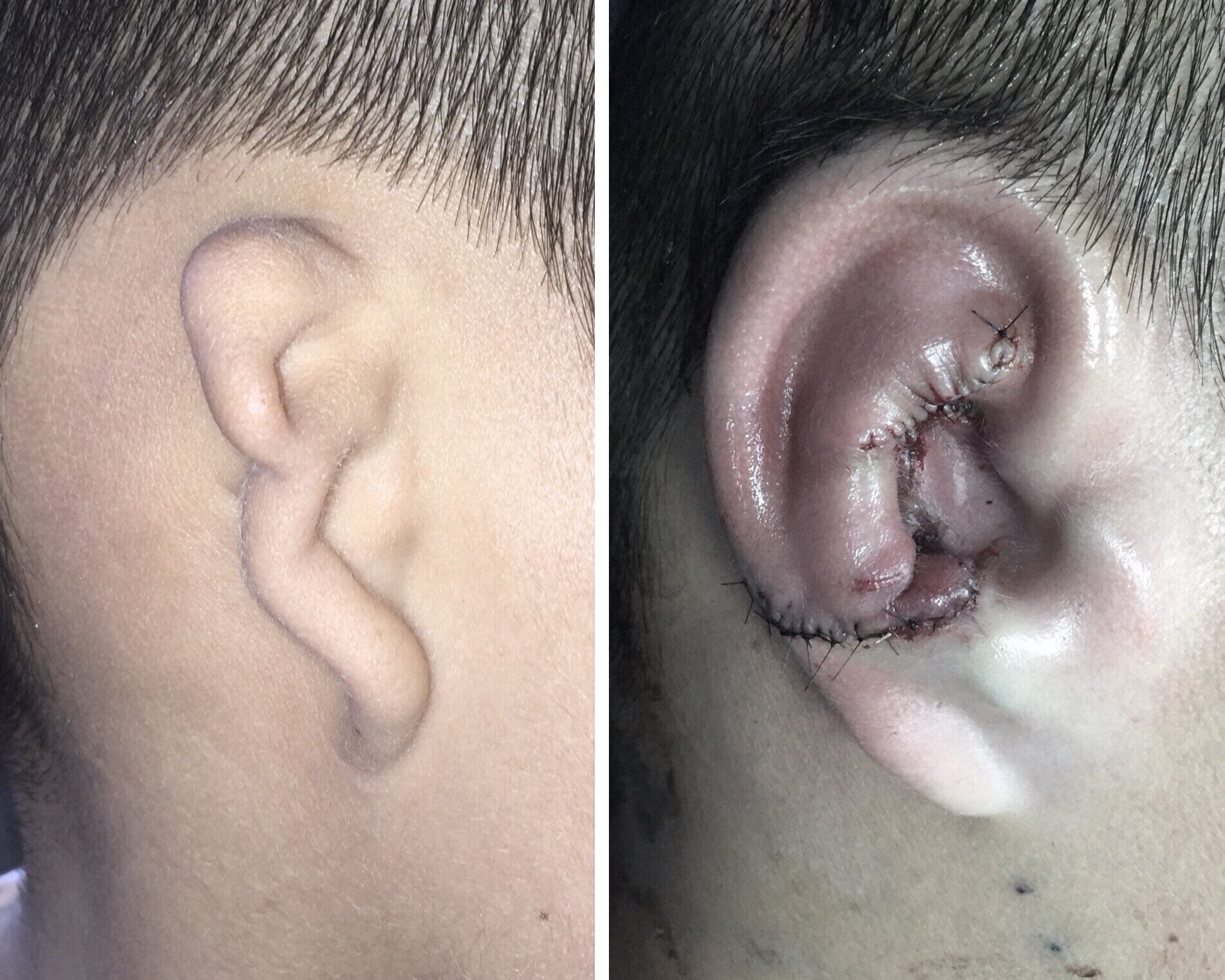 قبل و بعد جراحی گوش