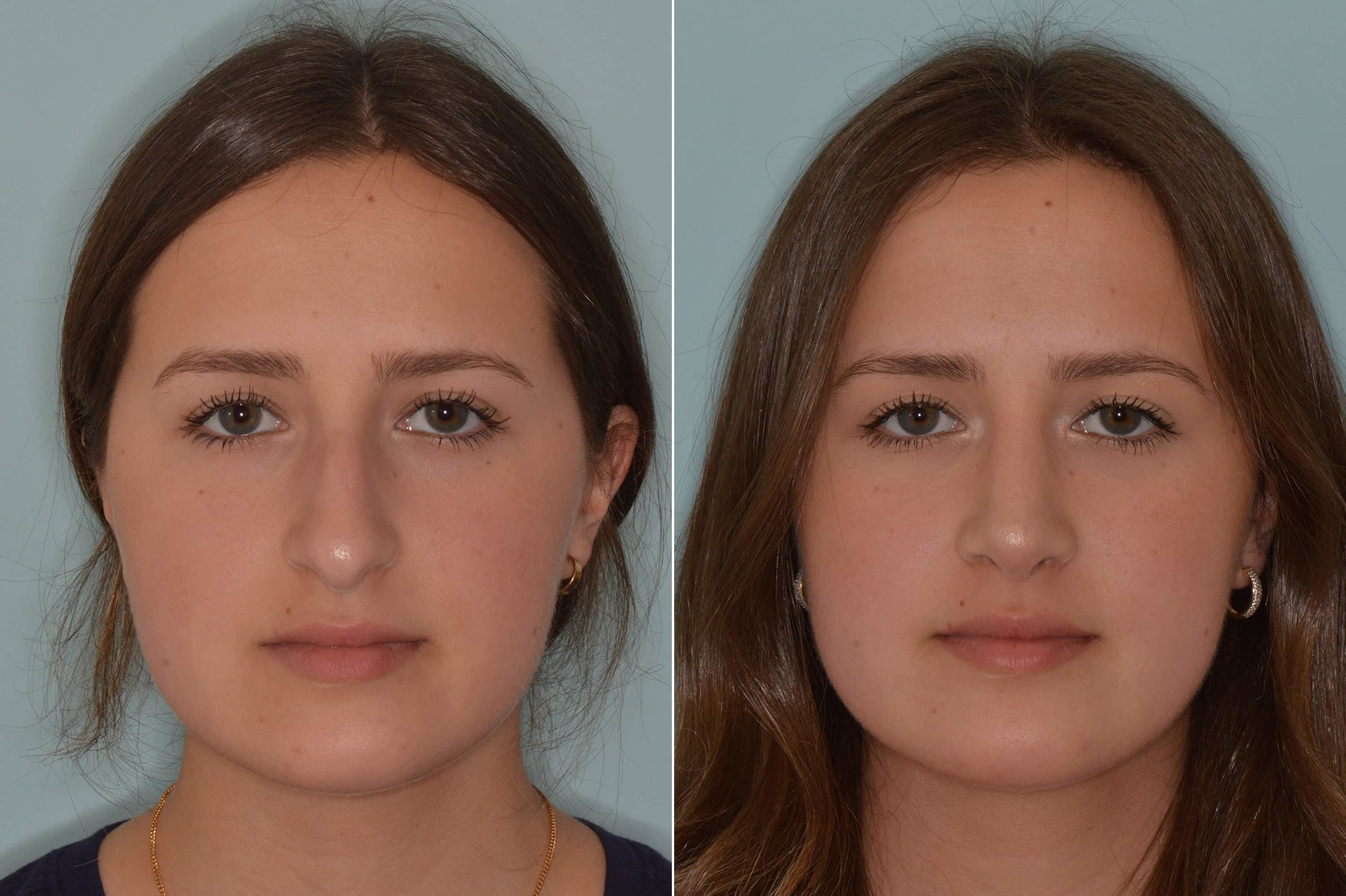 میزان تورم بینی قبل و بعد از عمل