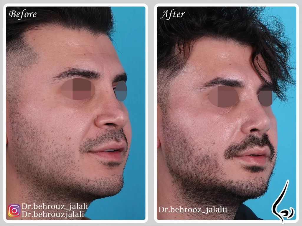 جراحی بینی ترمیمی