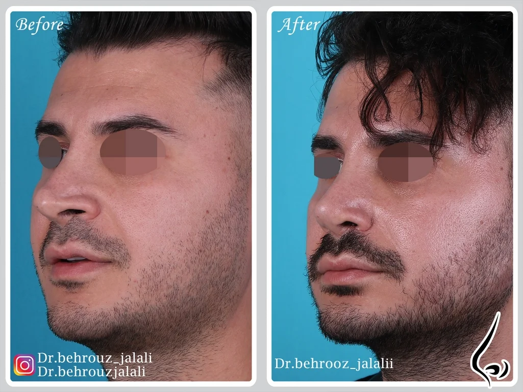 جراحی بینی ترمیمی