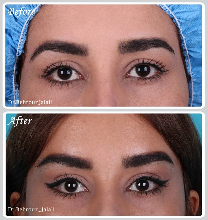 لیفت ابرو و شقیقه