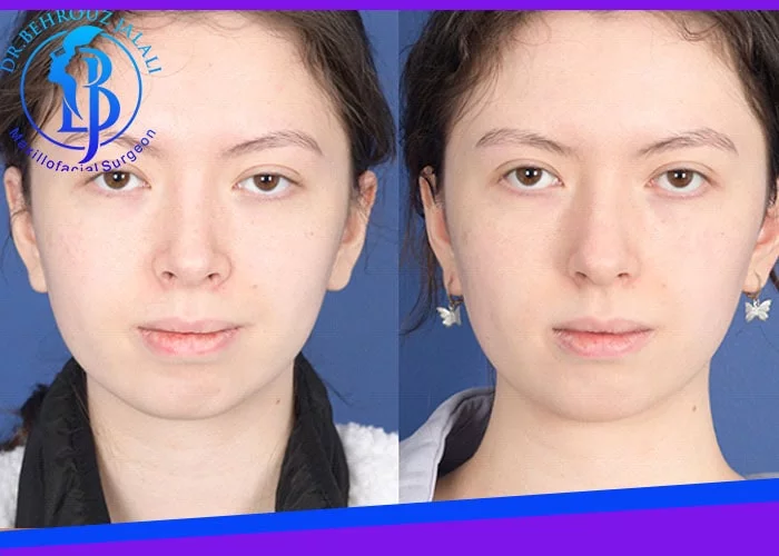 تزریق کورتون به بینی چه اثراتی دارد؟